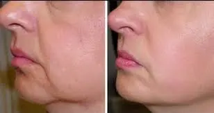 Before and after massage client 0