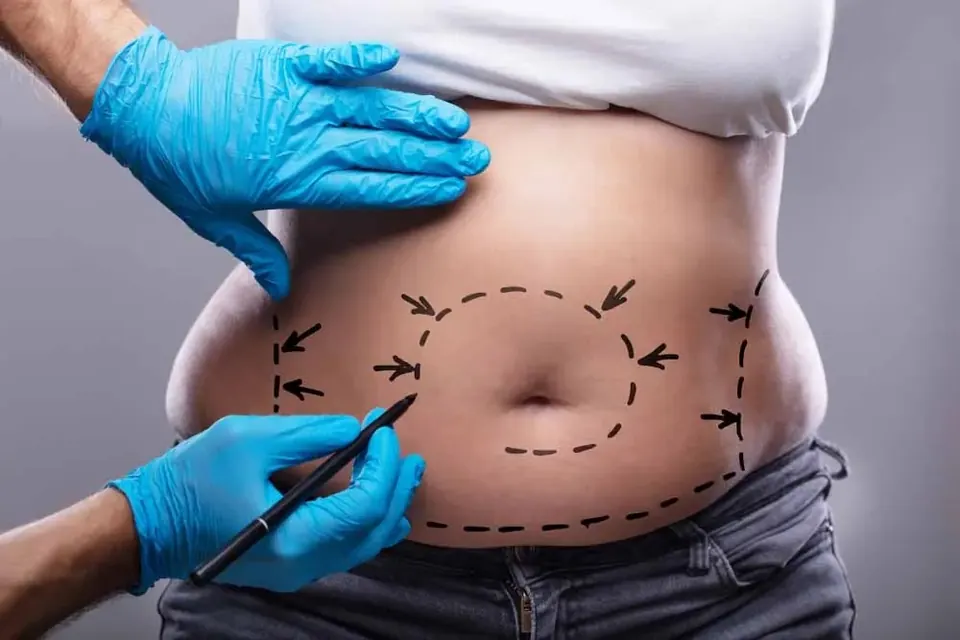 Why You’re Still Swollen Weeks After Lipo (Normal vs. Not Normal) — And How HealthSpa4u Can Help You Heal