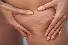 Cellulitis