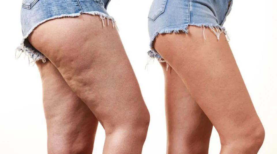 Lymphatic Massage for Lipedema Relief: Feel Lighter, Move Easier, Hurt Less