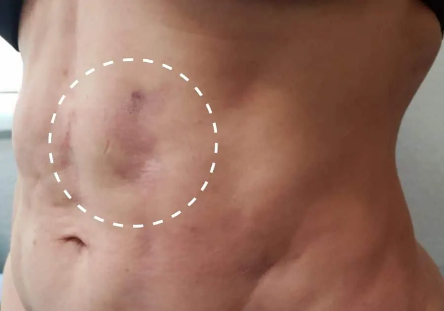 Why I still have fibrosis after lipo treatment
