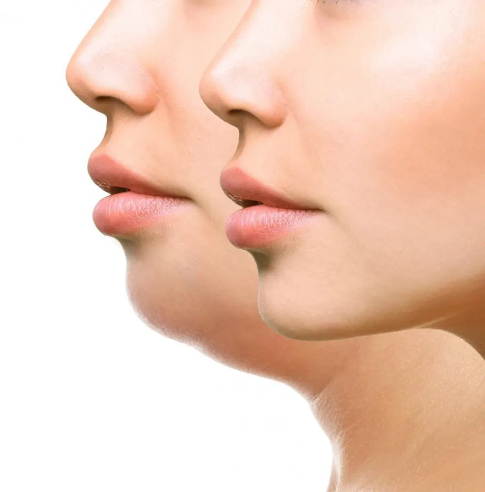 Post Lipo Chin Massage