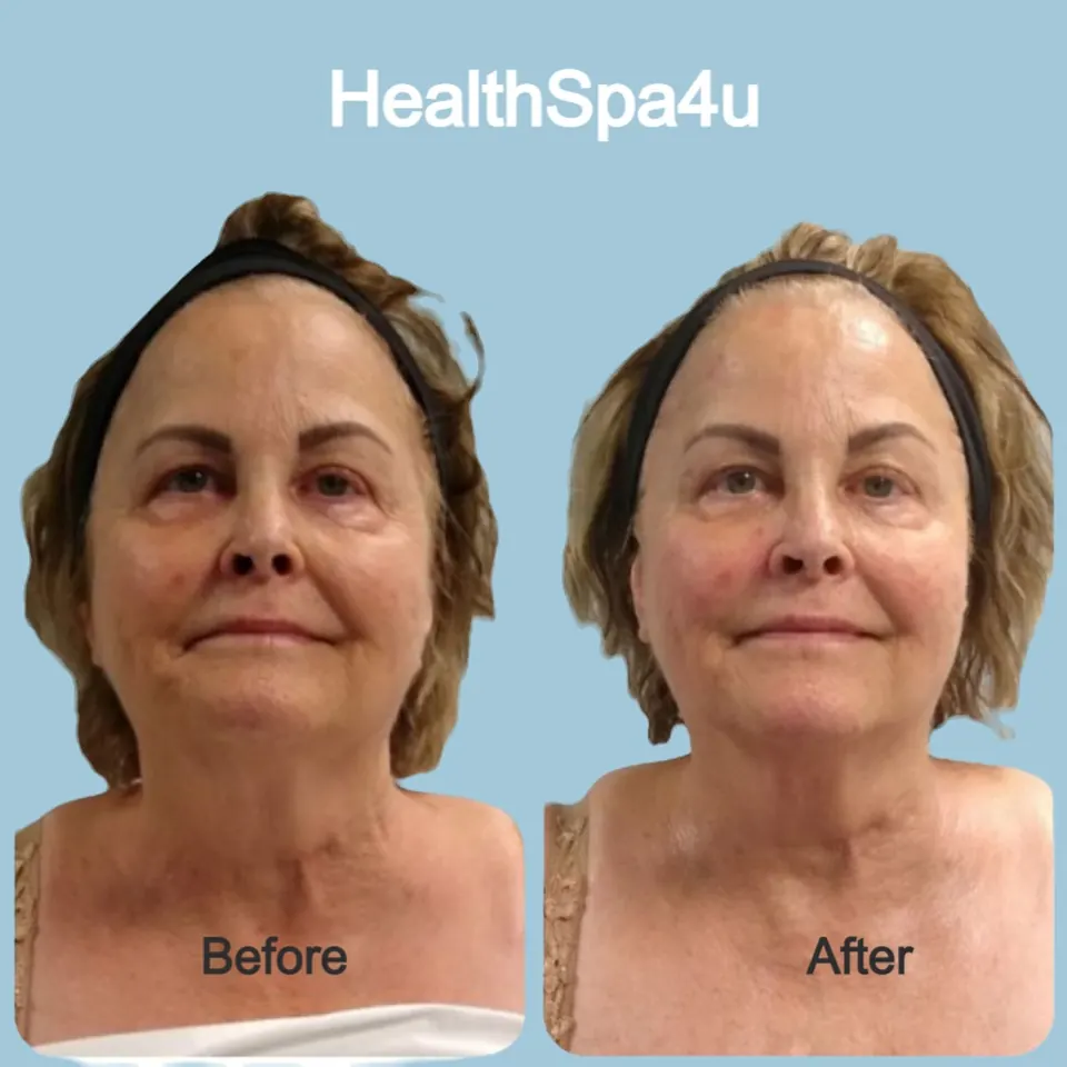 face sculpting and buccal massage